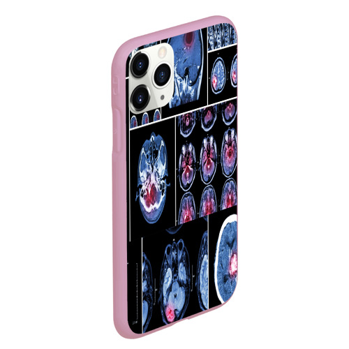Чехол для iPhone 11 Pro Max матовый с принтом Неврология, вид сбоку #3